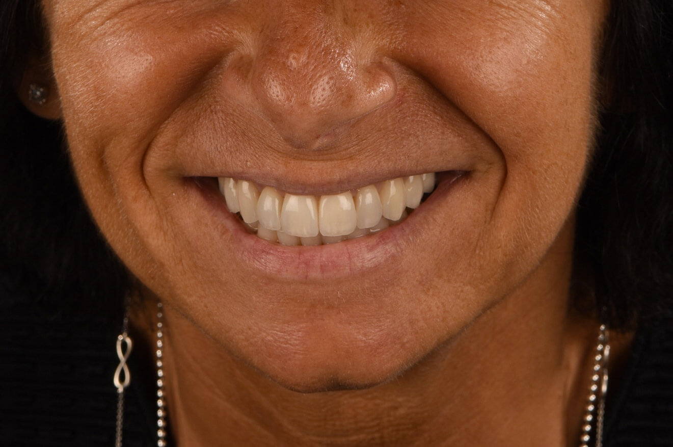 Sorriso paziente post trattamento sbiancamento e faccette ceramica - dentista Bologna e Faenza