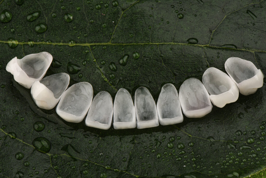 Faccette dentali in ceramica - Dr. frabboni