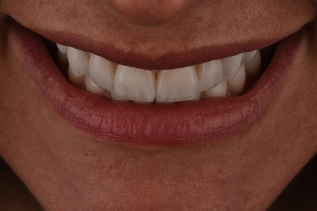Faccette dentali close-up